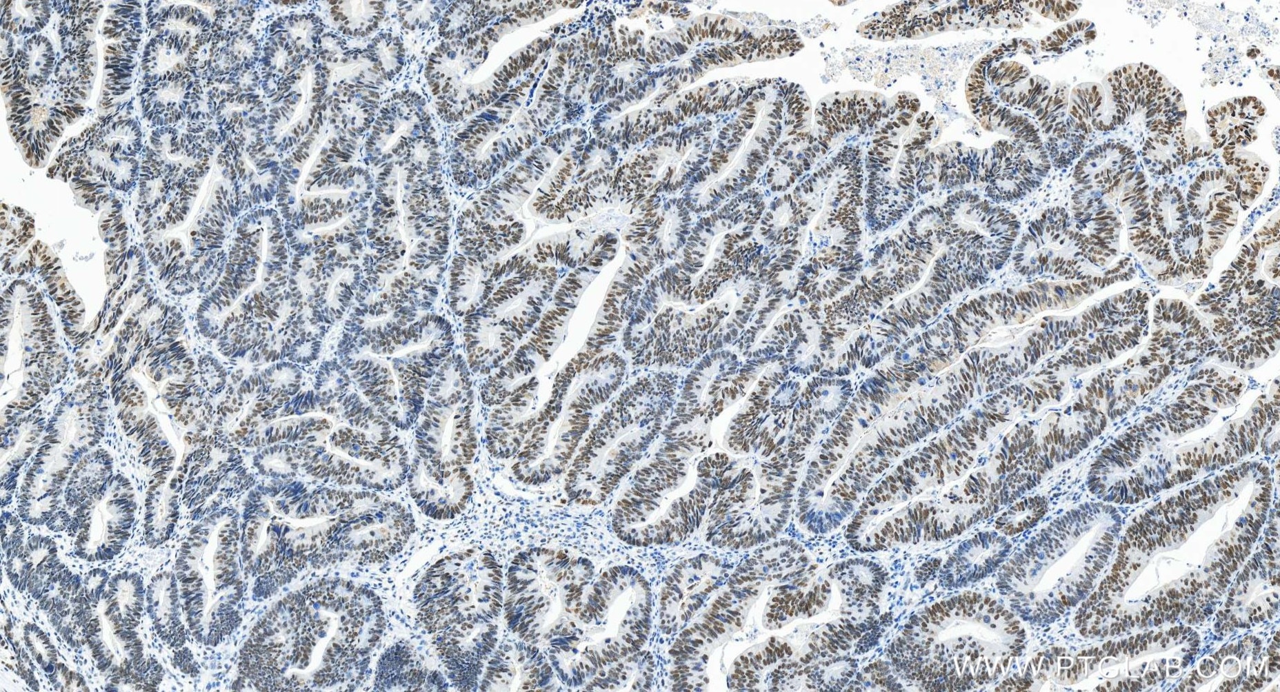 Immunohistochemistry (IHC) staining of human colon cancer tissue using HEXIM1 Recombinant antibody (85028-1-RR)