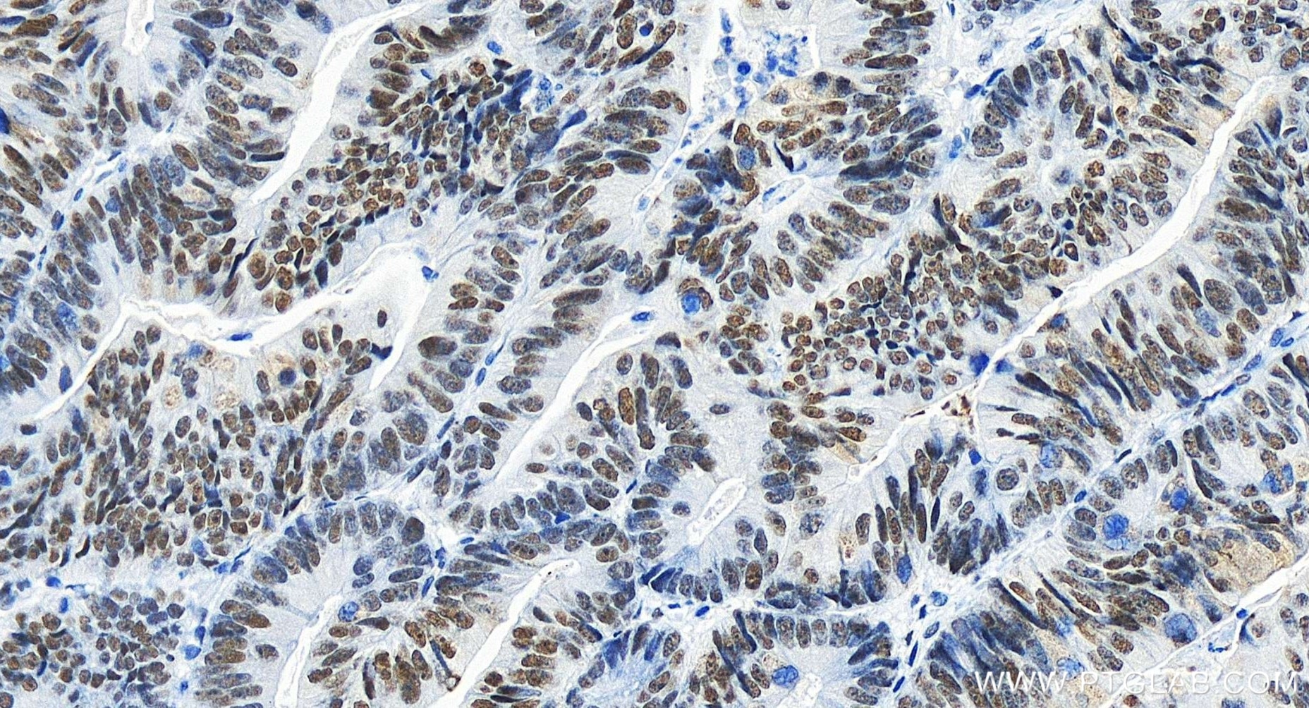 Immunohistochemistry (IHC) staining of human colon cancer tissue using HEXIM1 Recombinant antibody (85028-1-RR)