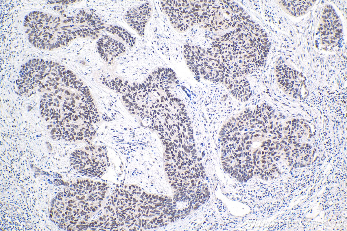 Immunohistochemistry (IHC) staining of human lung cancer tissue using HEXIM2 Polyclonal antibody (16598-1-AP)