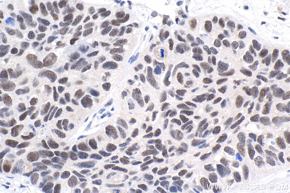 Immunohistochemistry (IHC) staining of human lung cancer tissue using HEXIM2 Polyclonal antibody (16598-1-AP)