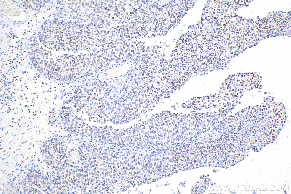 Immunohistochemistry (IHC) staining of human urothelial carcinoma tissue using HEXIM2 Polyclonal antibody (16598-1-AP)