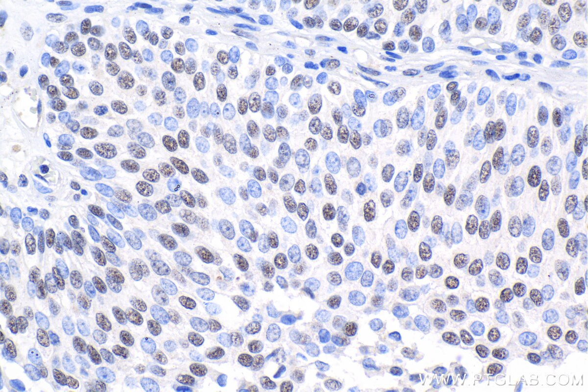 Immunohistochemistry (IHC) staining of human urothelial carcinoma tissue using HEXIM2 Polyclonal antibody (16598-1-AP)