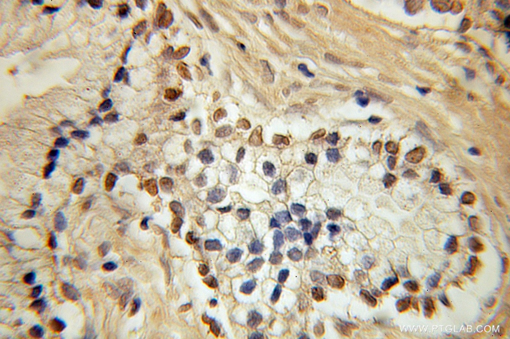 Immunohistochemistry (IHC) staining of human prostate cancer tissue using HEY2 Polyclonal antibody (10597-1-AP)