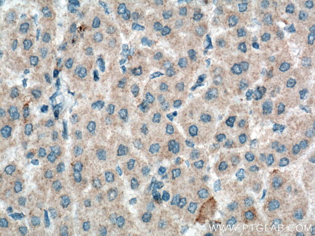 Immunohistochemistry (IHC) staining of human liver cancer tissue using HGF Alpha Polyclonal antibody (26881-1-AP)