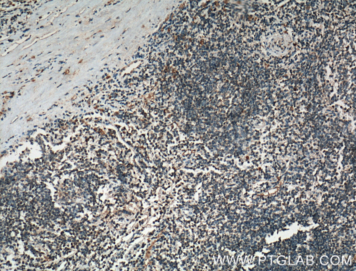 IHC staining of human tonsillitis using 26881-1-AP