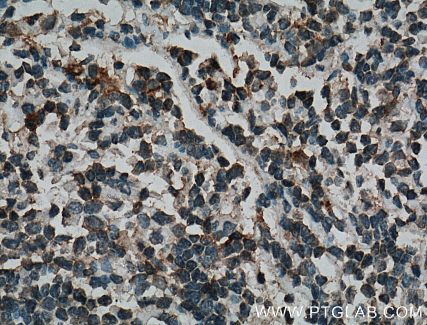 IHC staining of human tonsillitis using 26881-1-AP