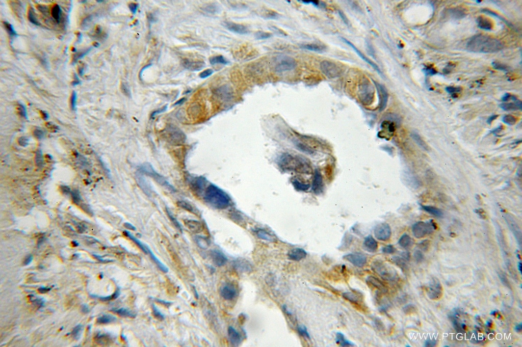 Immunohistochemistry (IHC) staining of human lung cancer tissue using HGSNAT Polyclonal antibody (12399-1-AP)
