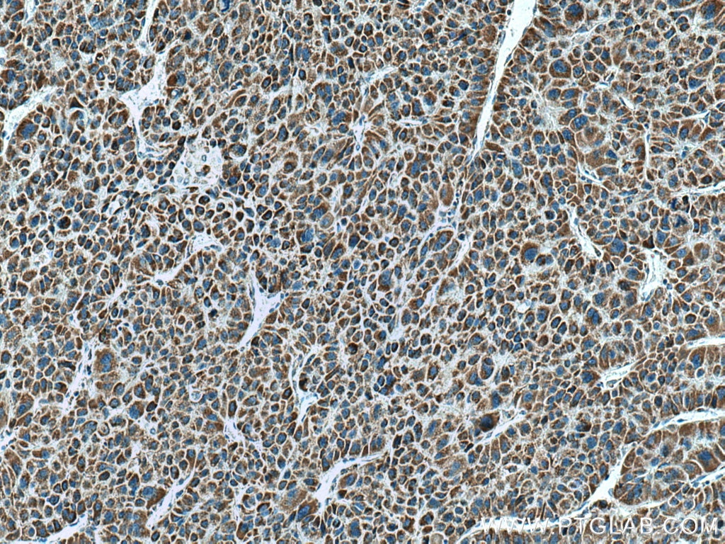 Immunohistochemistry (IHC) staining of human liver cancer tissue using HIBADH Polyclonal antibody (13466-1-AP)