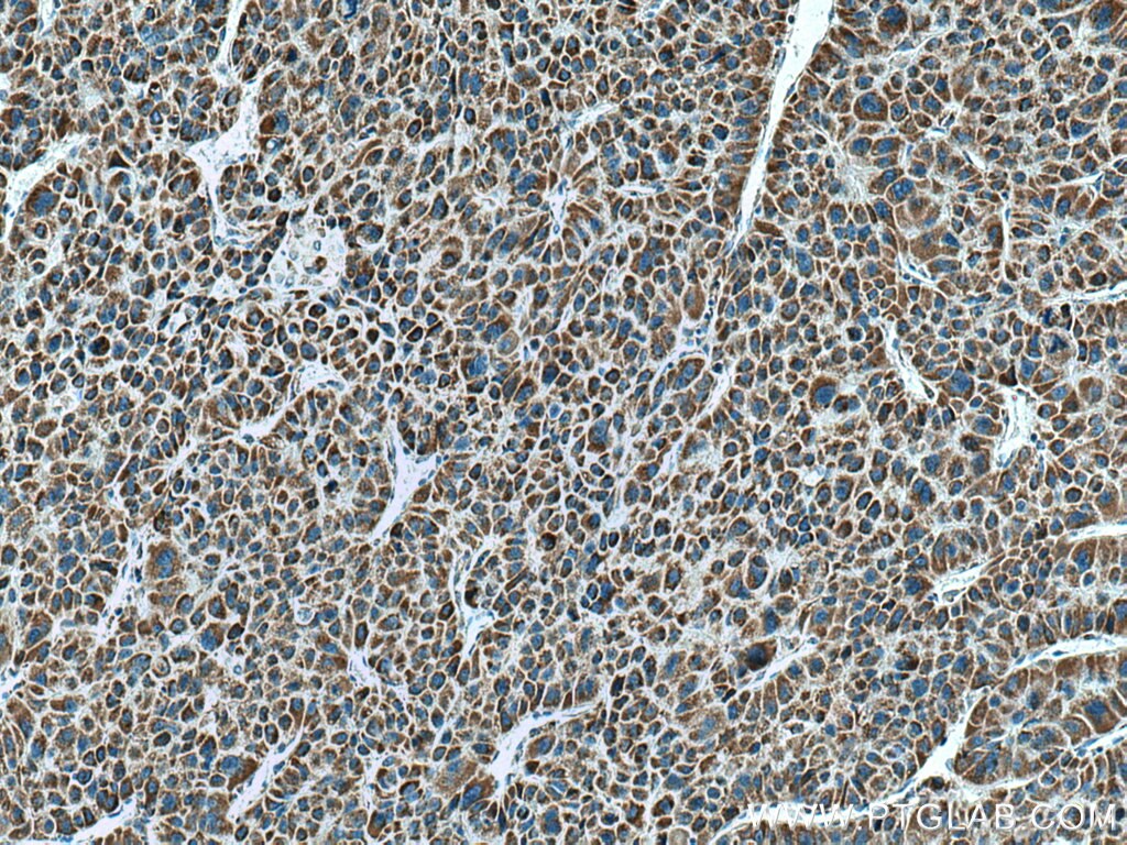 Immunohistochemistry (IHC) staining of human liver cancer tissue using HIBADH Polyclonal antibody (13466-1-AP)