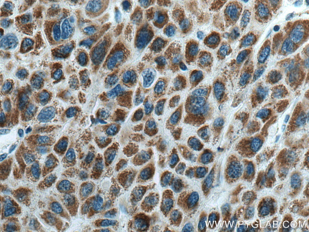 Immunohistochemistry (IHC) staining of human liver cancer tissue using HIBADH Polyclonal antibody (13466-1-AP)