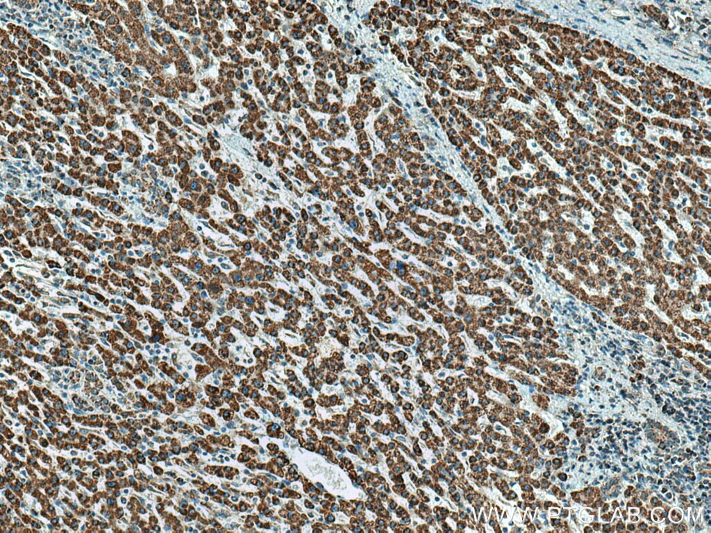 Immunohistochemistry (IHC) staining of human liver cancer tissue using HIBADH Polyclonal antibody (13466-1-AP)