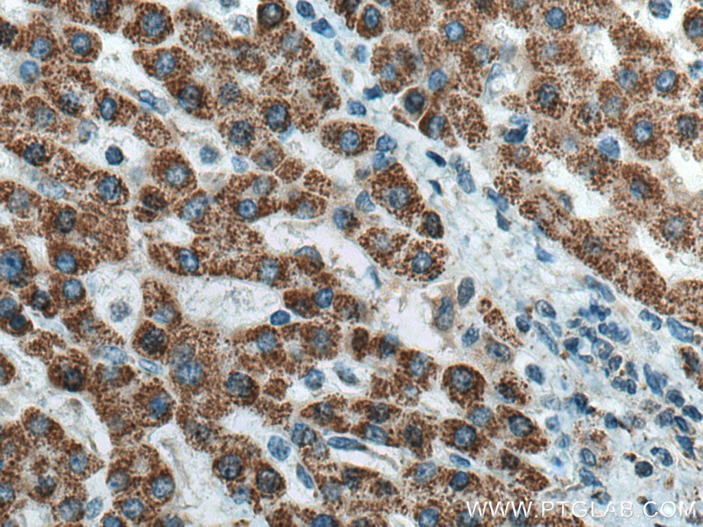 IHC staining of human liver cancer using 13466-1-AP