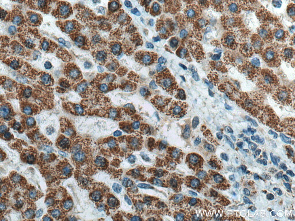 Immunohistochemistry (IHC) staining of human liver cancer tissue using HIBADH Polyclonal antibody (13466-1-AP)