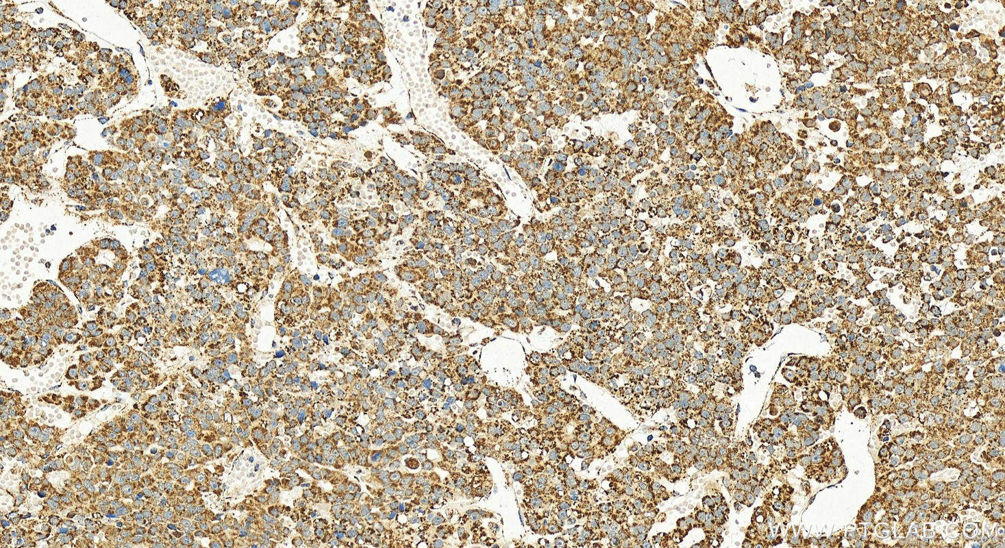 Immunohistochemical analysis of paraffin-embedded human hepatocellular carcinoma slide using 14603-1-AP (HIBCH antibody) at dilution of 1:800 (under 20x lens). Heat mediated antigen retrieval with Tris-EDTA buffer (pH 9.0). Immunohistochemistry (IHC) staining of human hepatocellular carcinoma using HIBCH Polyclonal antibody (14603-1-AP)