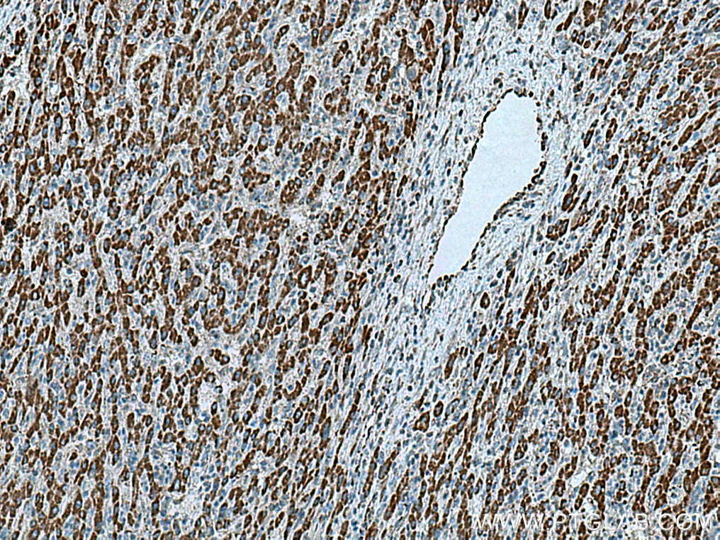 Immunohistochemistry (IHC) staining of human liver cancer tissue using HIBCH Polyclonal antibody (14603-1-AP)