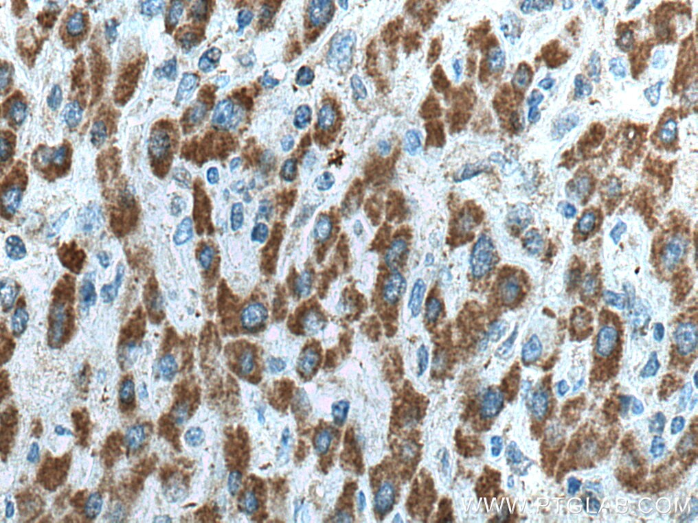 Immunohistochemistry (IHC) staining of human liver cancer tissue using HIBCH Polyclonal antibody (14603-1-AP)