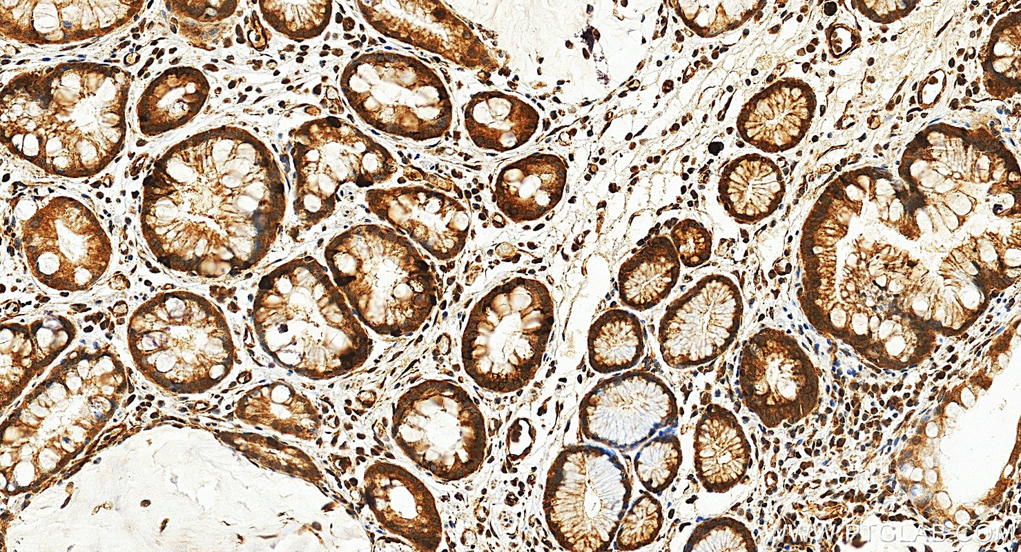 Immunohistochemical analysis of paraffin-embedded human stomach cancer tissue slide using 20960-1-AP (HIF-1 alpha antibody) at dilution of 1:200 (under 20x lens). Heat mediated antigen retrieval with Tris-EDTA buffer (pH 9.0). Immunohistochemistry (IHC) staining of human stomach cancer tissue using HIF-1 alpha Polyclonal antibody (20960-1-AP)