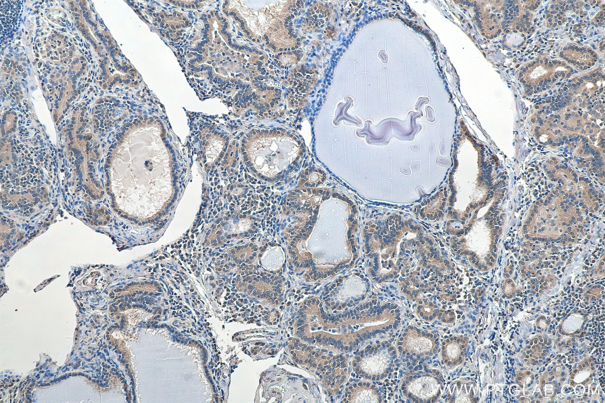 Immunohistochemistry (IHC) staining of human thyroid cancer tissue using HIF-1 alpha Polyclonal antibody (20960-1-AP)