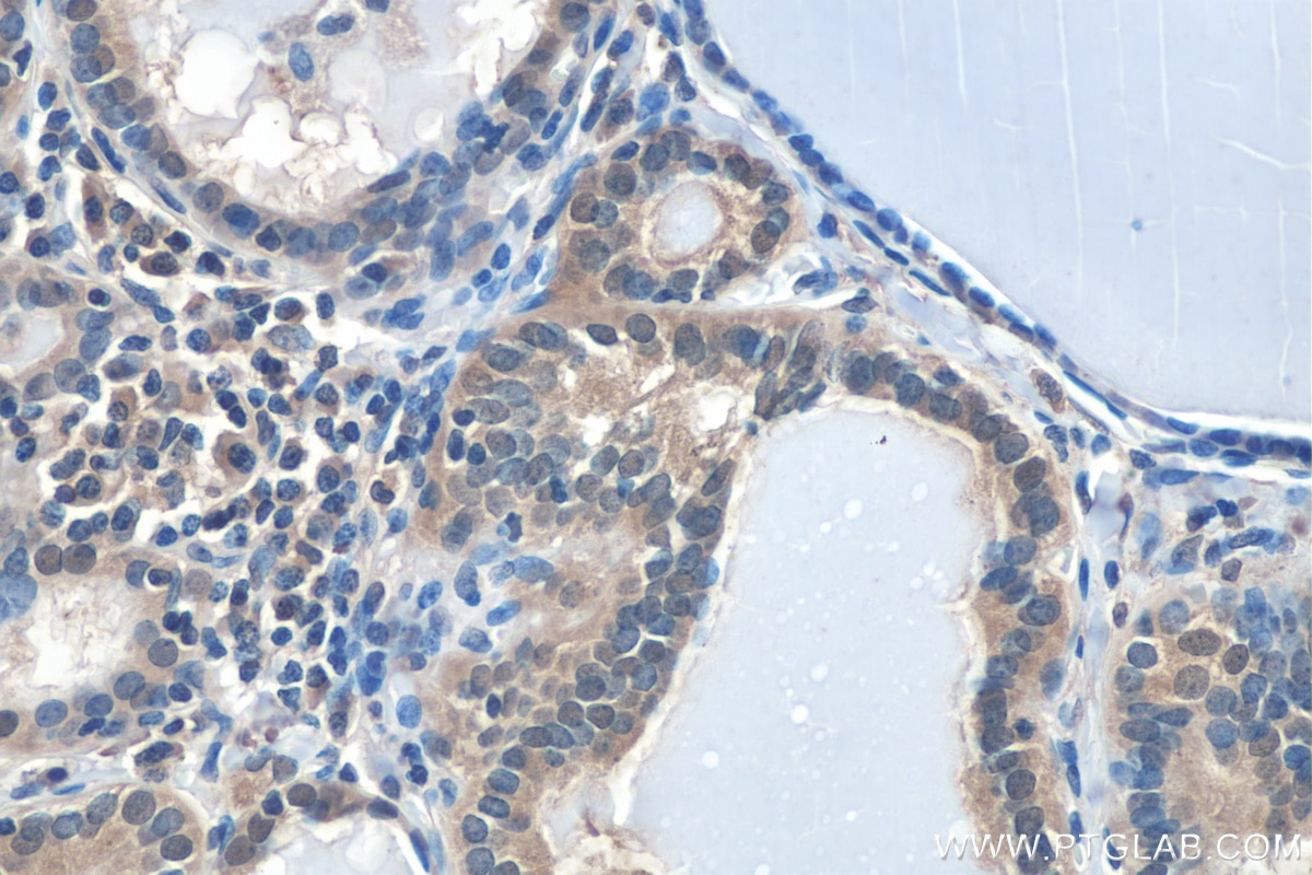 Immunohistochemistry (IHC) staining of human thyroid cancer tissue using HIF1a Polyclonal antibody (20960-1-AP)