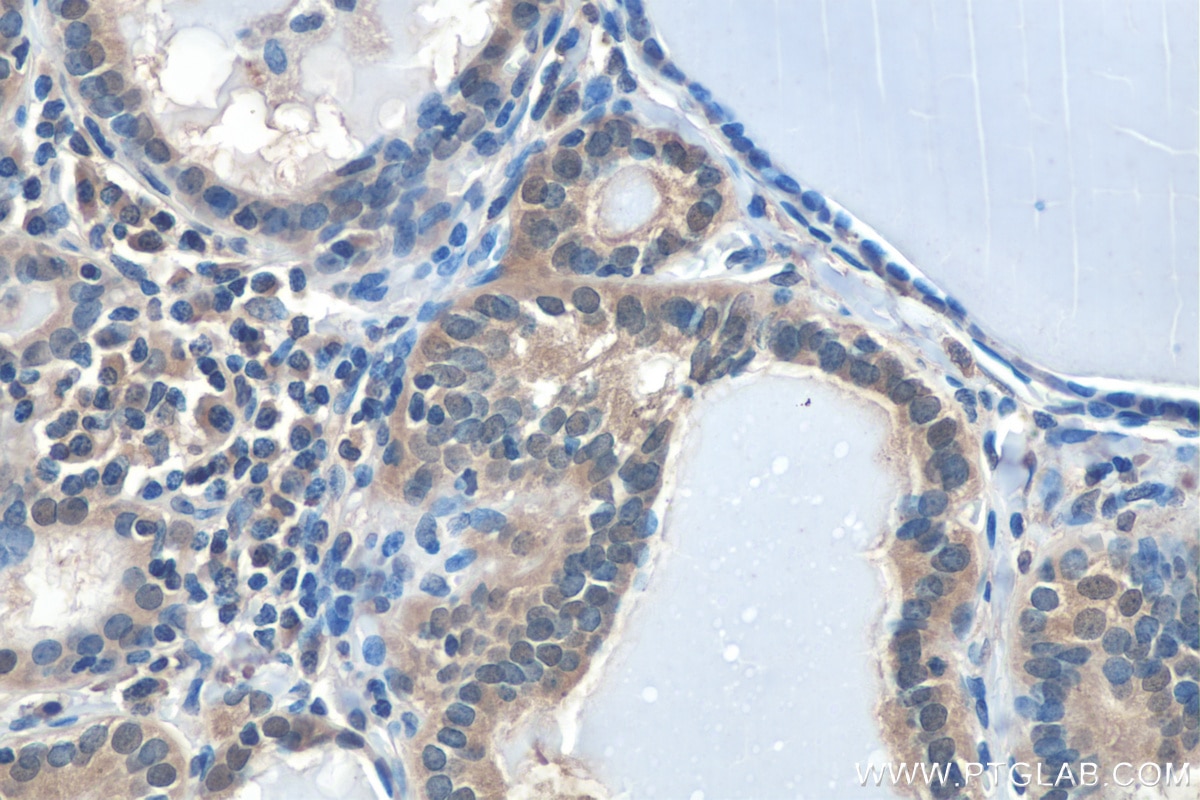 IHC staining of human thyroid cancer using 20960-1-AP