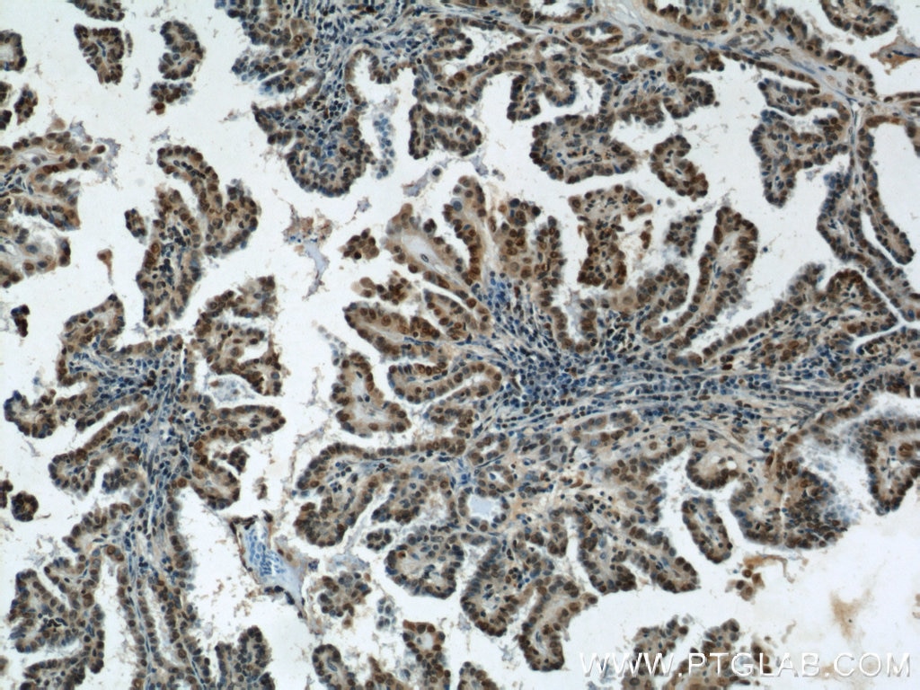 Immunohistochemistry (IHC) staining of human thyroid cancer tissue using HIF-1 alpha Polyclonal antibody (20960-1-AP)