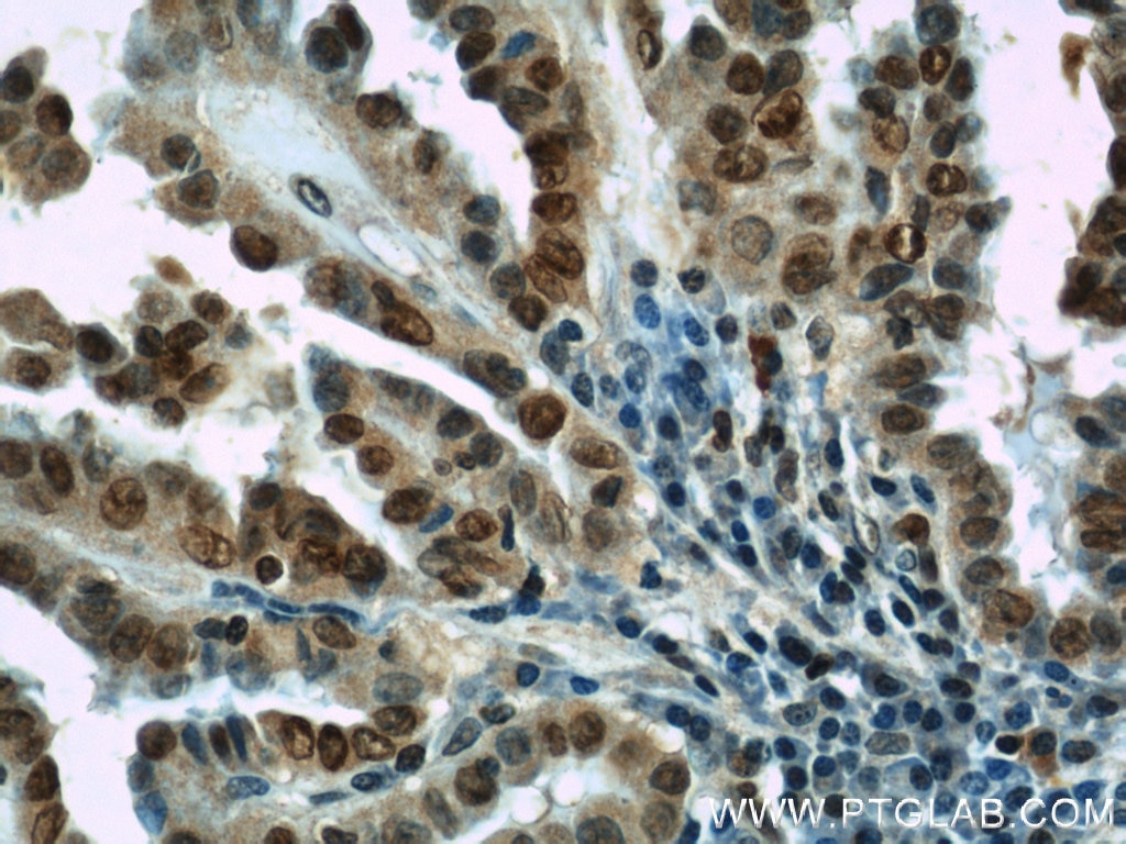 Immunohistochemistry (IHC) staining of human thyroid cancer tissue using HIF-1 alpha Polyclonal antibody (20960-1-AP)