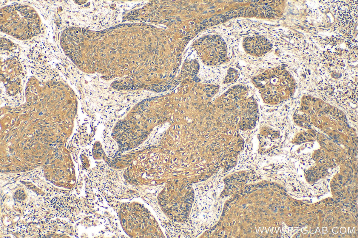 Immunohistochemistry (IHC) staining of human lung cancer tissue using HIF1AN Polyclonal antibody (10646-1-AP)