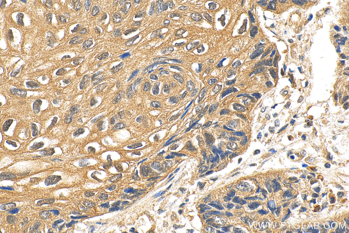 Immunohistochemistry (IHC) staining of human lung cancer tissue using HIF1AN Polyclonal antibody (10646-1-AP)