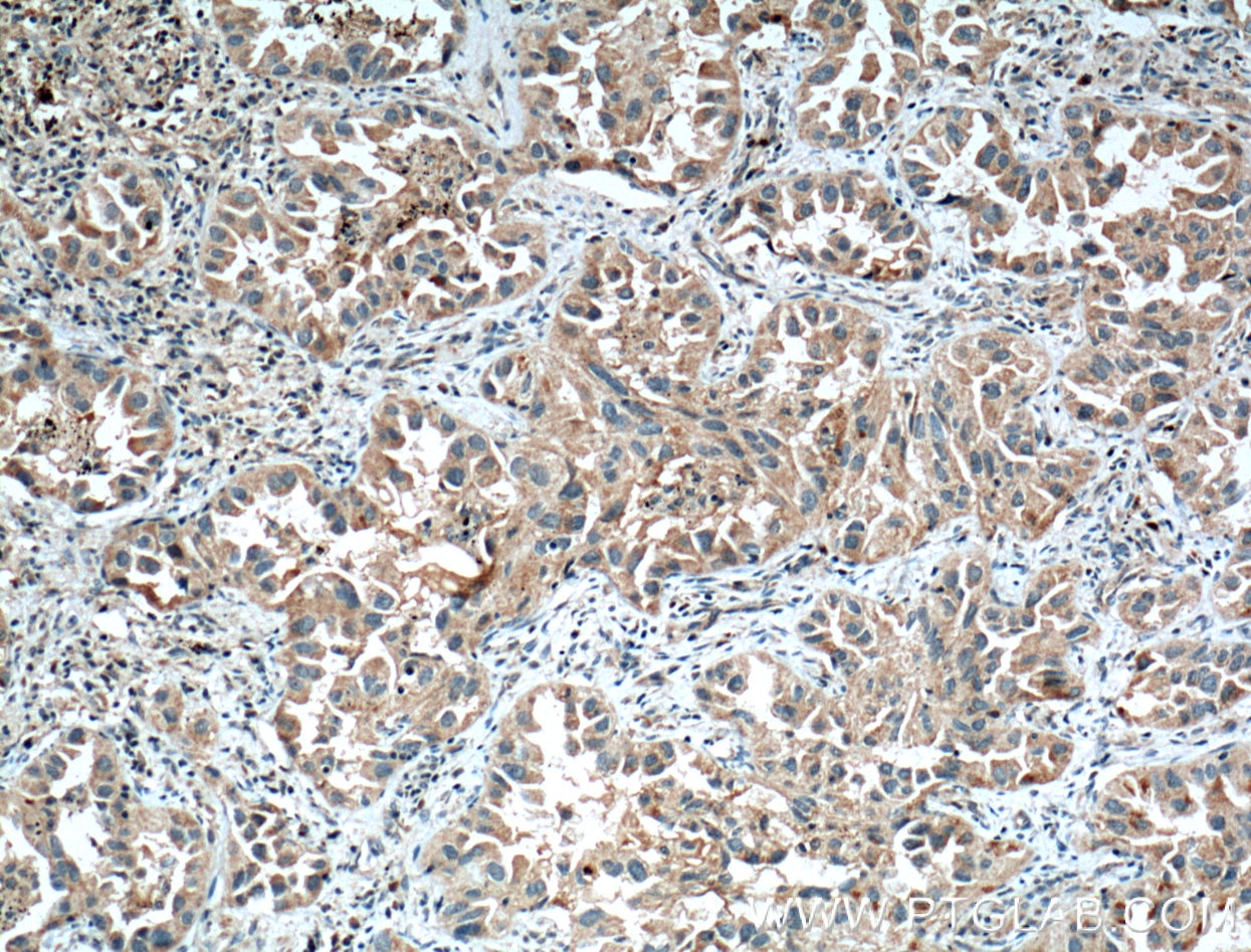 IHC staining of human lung cancer using 10646-1-AP