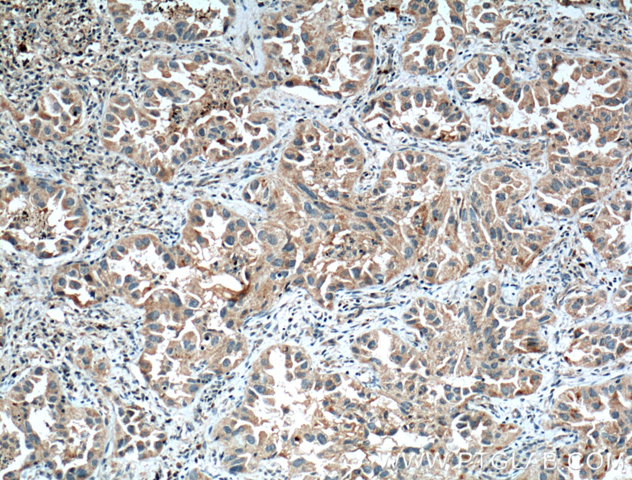 Immunohistochemistry (IHC) staining of human lung cancer tissue using HIF1AN Polyclonal antibody (10646-1-AP)