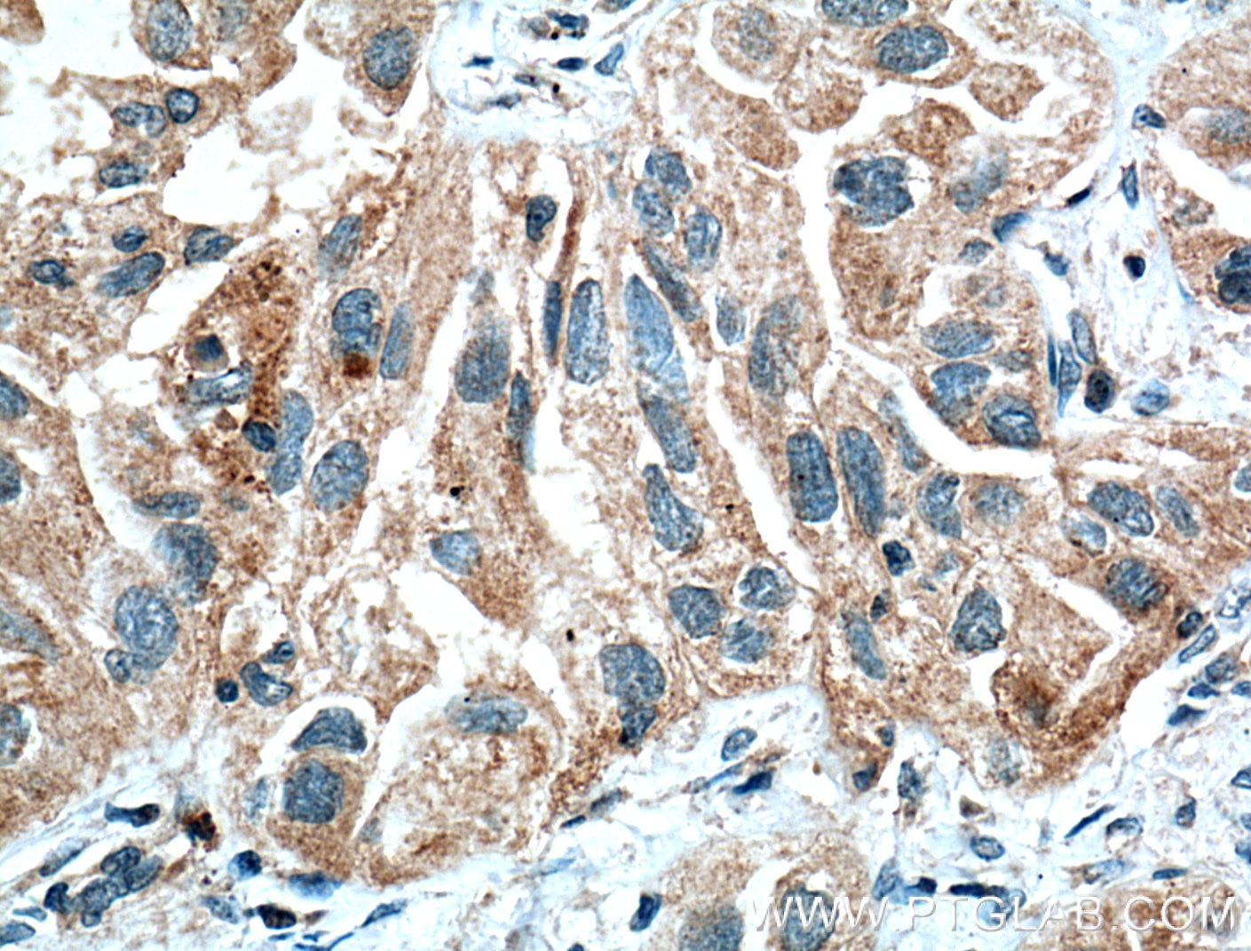 IHC staining of human lung cancer using 10646-1-AP