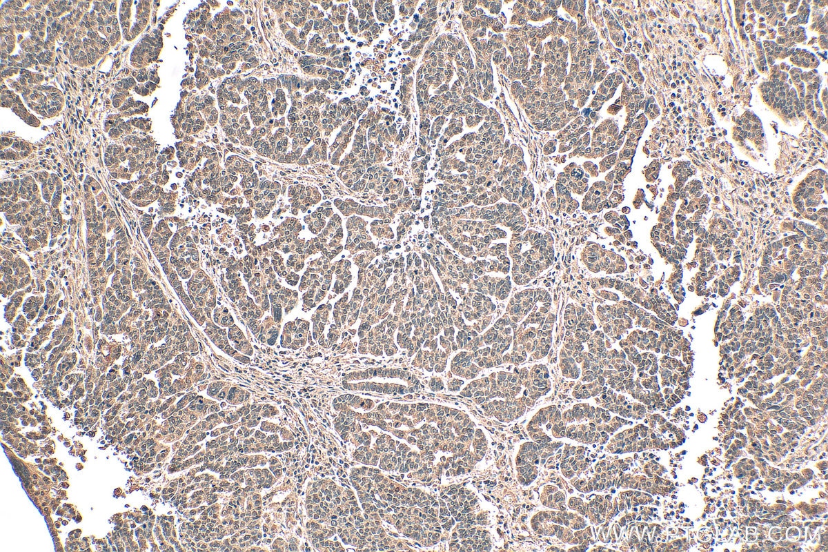 Immunohistochemistry (IHC) staining of human ovary tumor tissue using HIF-1 alpha Monoclonal antibody (66730-1-Ig)