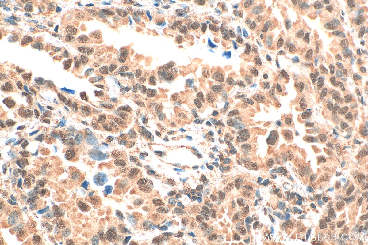 Immunohistochemistry (IHC) staining of human lung cancer tissue using HIF-1 alpha Monoclonal antibody (66730-1-Ig)