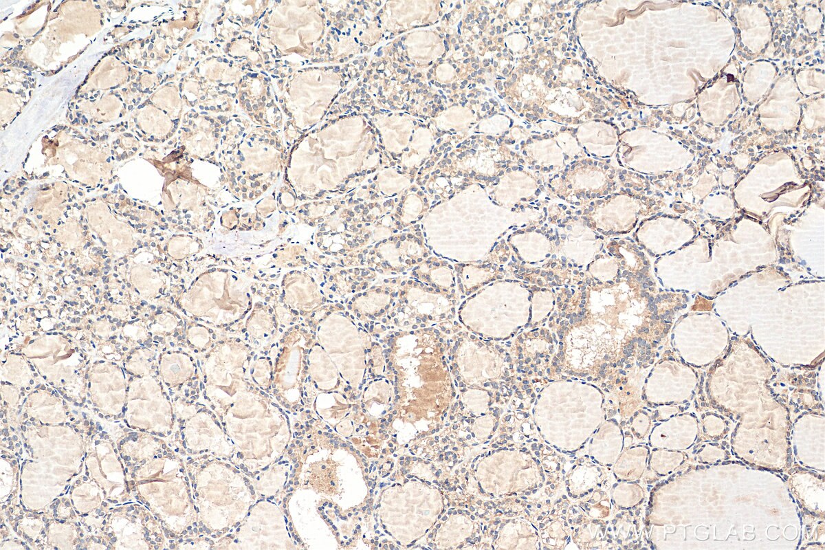 IHC staining of human thyroid cancer using 80933-1-RR