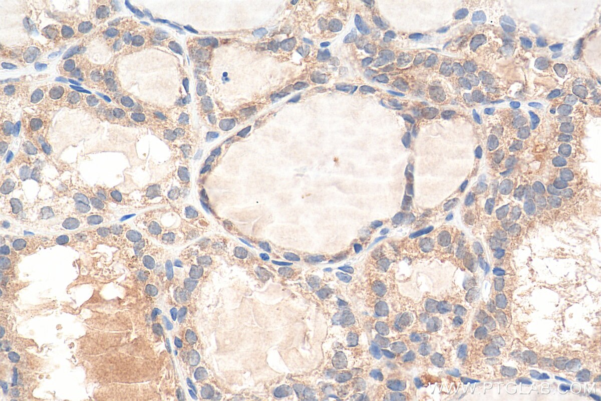 IHC staining of human thyroid cancer using 80933-1-RR