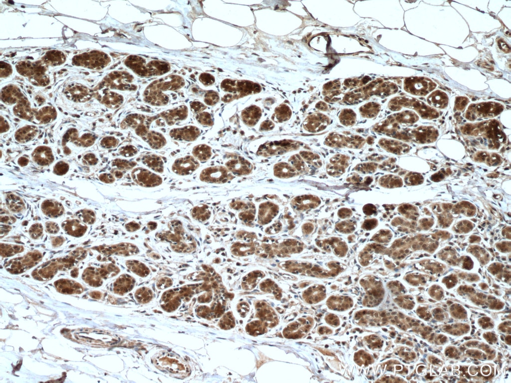 Immunohistochemistry (IHC) staining of human breast cancer tissue using HINT1 Polyclonal antibody (10717-1-AP)