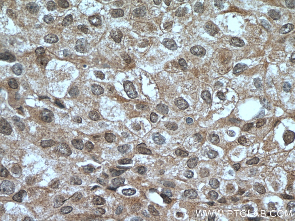 Immunohistochemistry (IHC) staining of human breast cancer tissue using HINT1 Polyclonal antibody (10717-1-AP)