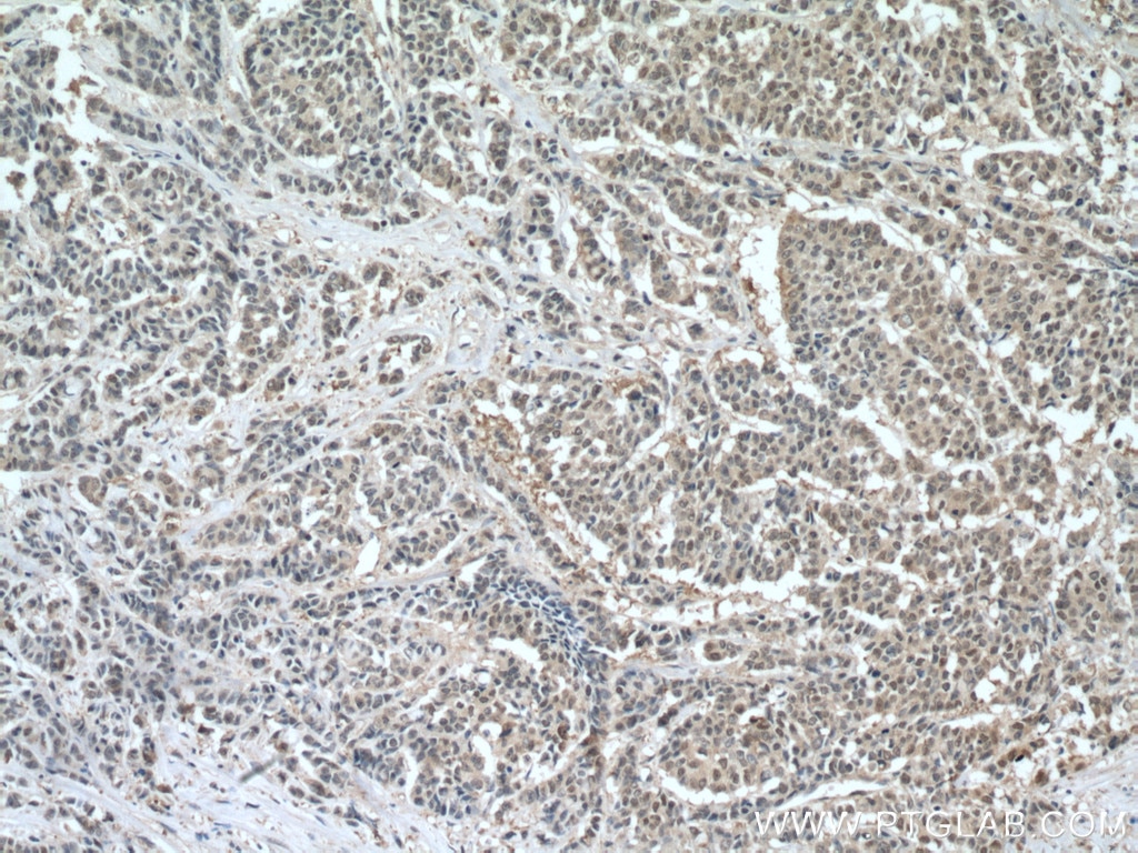 Immunohistochemistry (IHC) staining of human colon cancer tissue using HINT1 Polyclonal antibody (10717-1-AP)