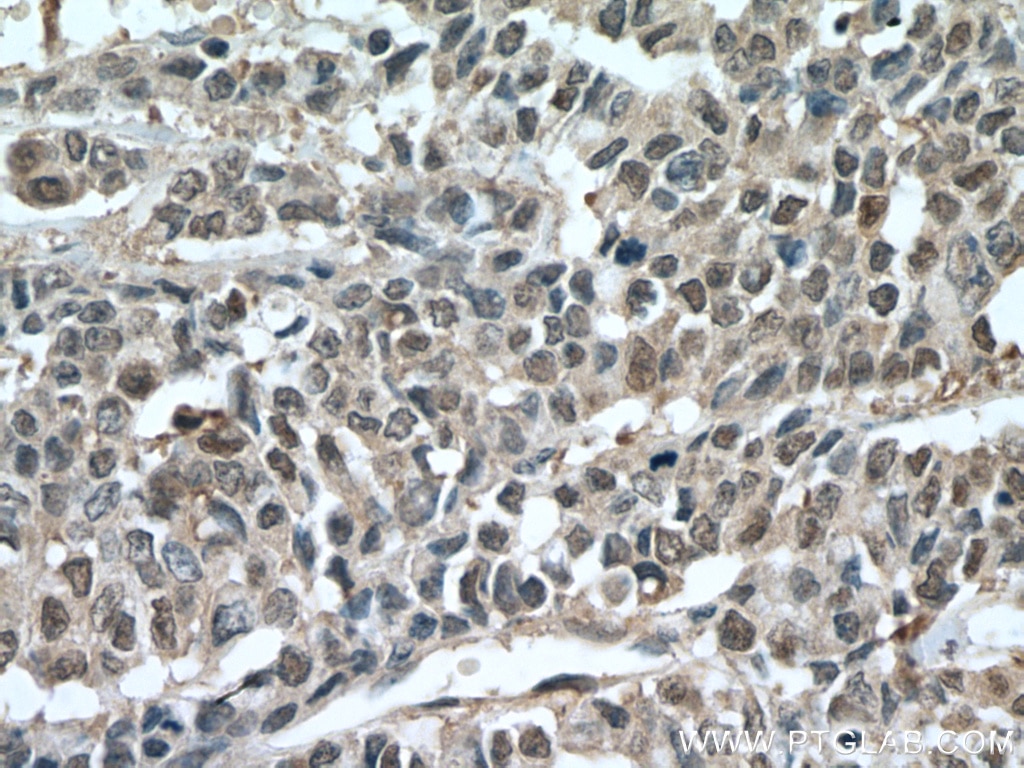 Immunohistochemistry (IHC) staining of human colon cancer tissue using HINT1 Polyclonal antibody (10717-1-AP)