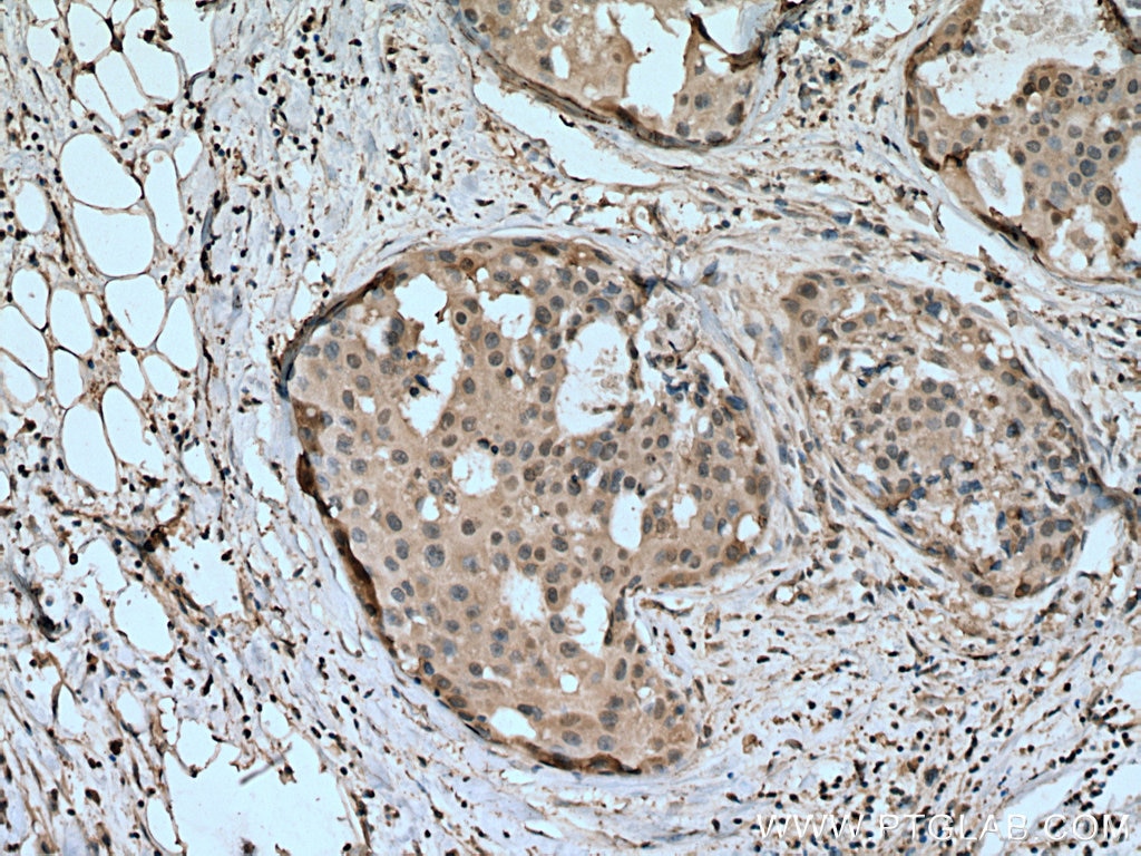 Immunohistochemistry (IHC) staining of human breast cancer tissue using HINT1 Monoclonal antibody (67583-1-Ig)