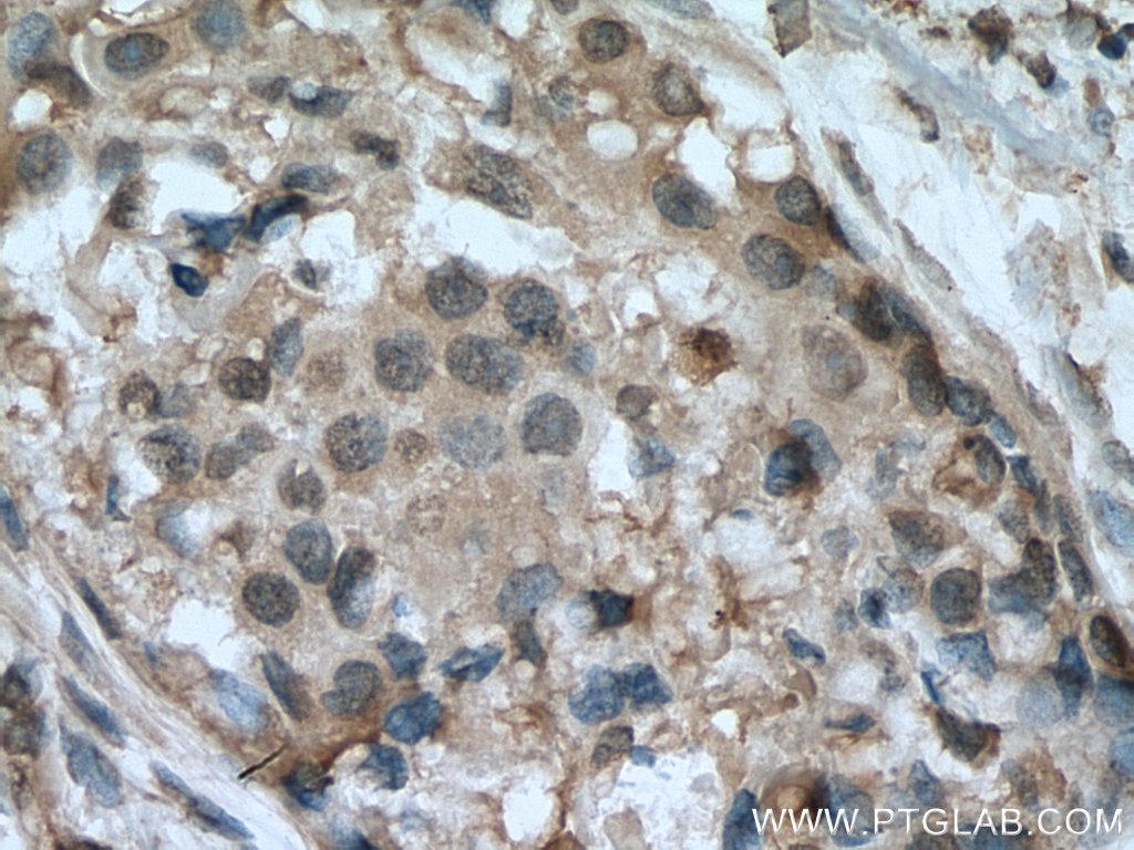 Immunohistochemistry (IHC) staining of human breast cancer tissue using HINT1 Monoclonal antibody (67583-1-Ig)