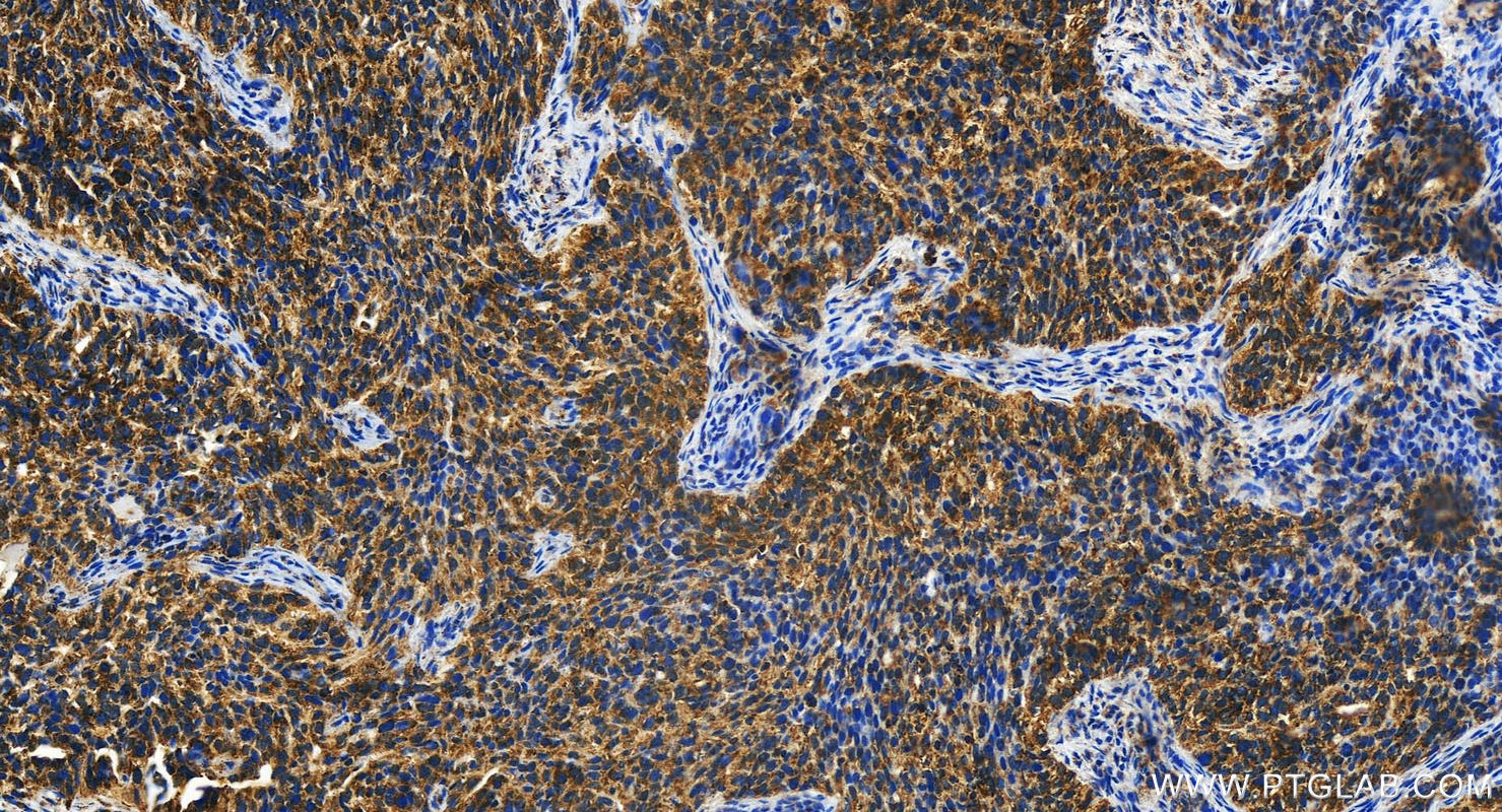 Immunohistochemistry (IHC) staining of human ovary cancer tissue using HINT2 Polyclonal antibody (17986-1-AP)