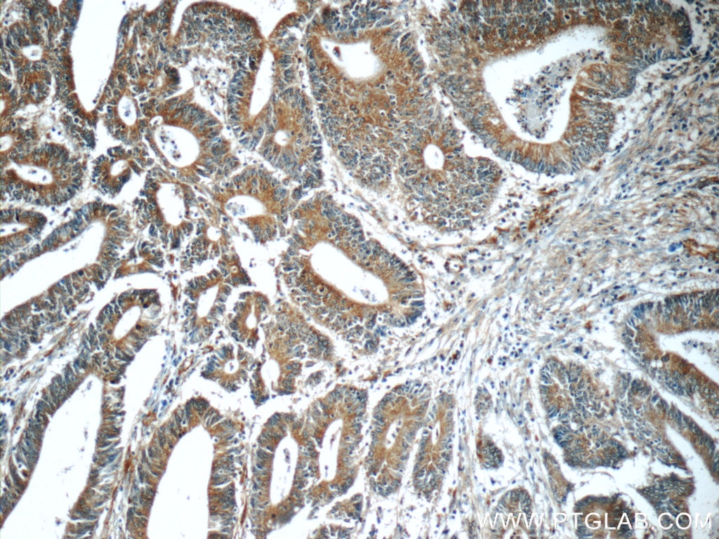 Immunohistochemistry (IHC) staining of human colon cancer tissue using HIP1 Polyclonal antibody (22231-1-AP)