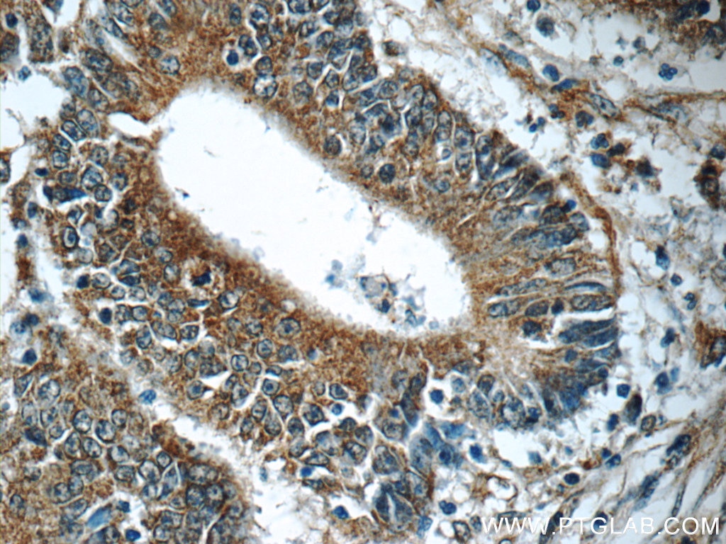 Immunohistochemistry (IHC) staining of human colon cancer tissue using HIP1 Polyclonal antibody (22231-1-AP)