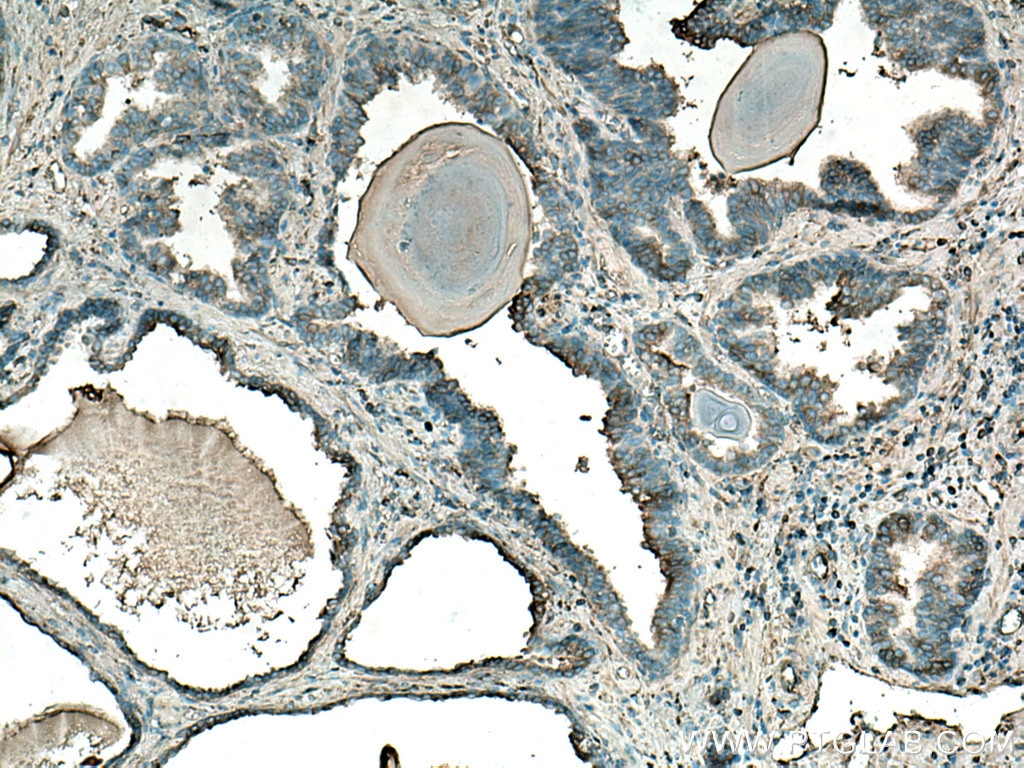 Immunohistochemistry (IHC) staining of human prostate cancer tissue using HIP1 Polyclonal antibody (22231-1-AP)