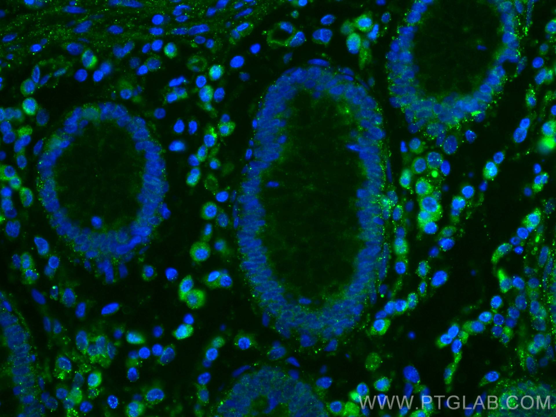Immunofluorescence (IF) / fluorescent staining of human colon cancer tissue using HIP1 Monoclonal antibody (67163-1-Ig)