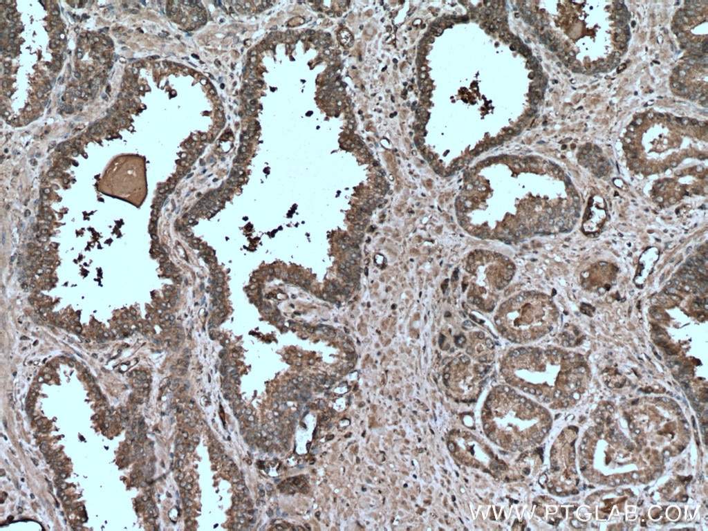 Immunohistochemistry (IHC) staining of human prostate cancer tissue using HIP1 Monoclonal antibody (67163-1-Ig)