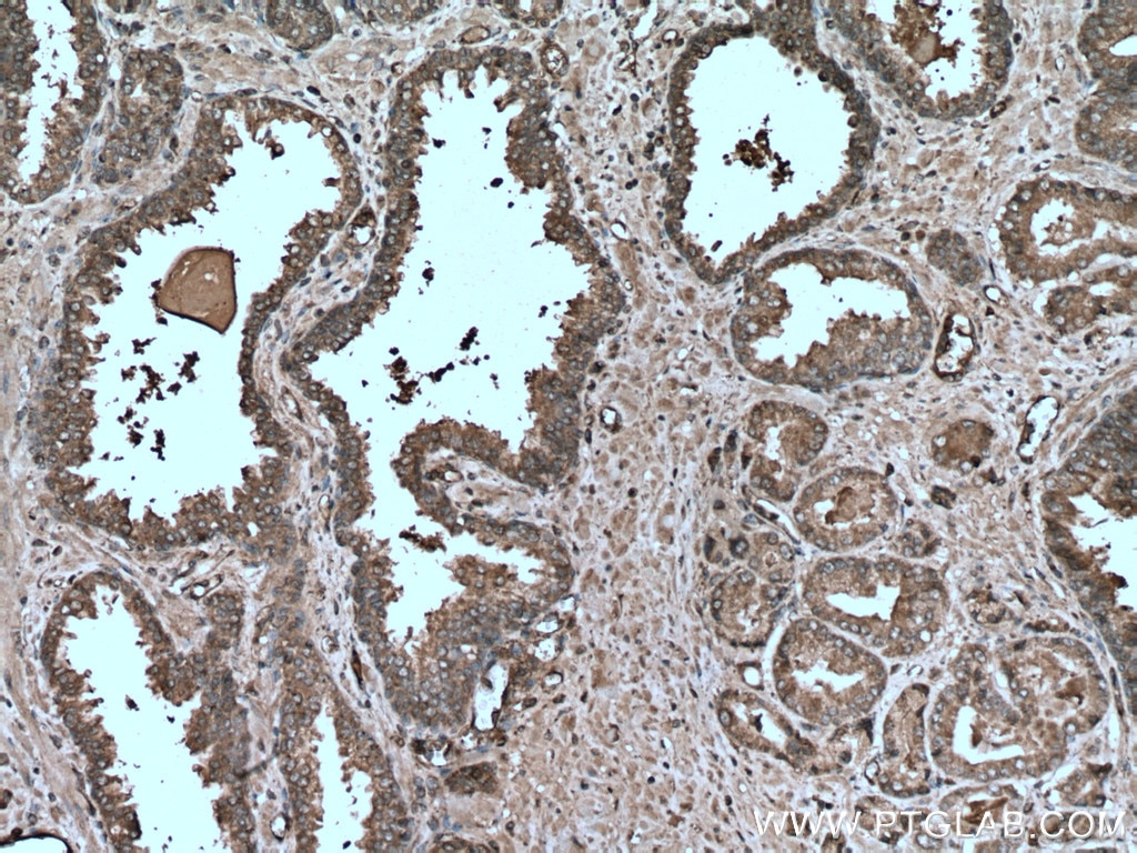 IHC staining of human prostate cancer using 67163-1-Ig