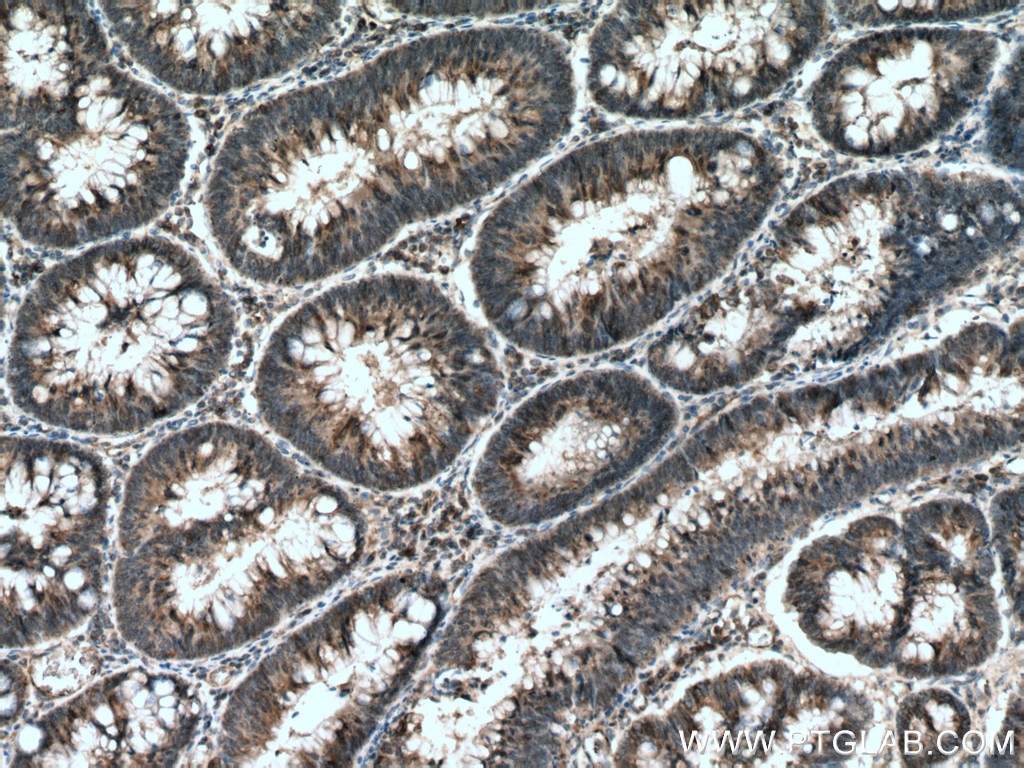 Immunohistochemistry (IHC) staining of human colon cancer tissue using HIP1 Monoclonal antibody (67163-1-Ig)