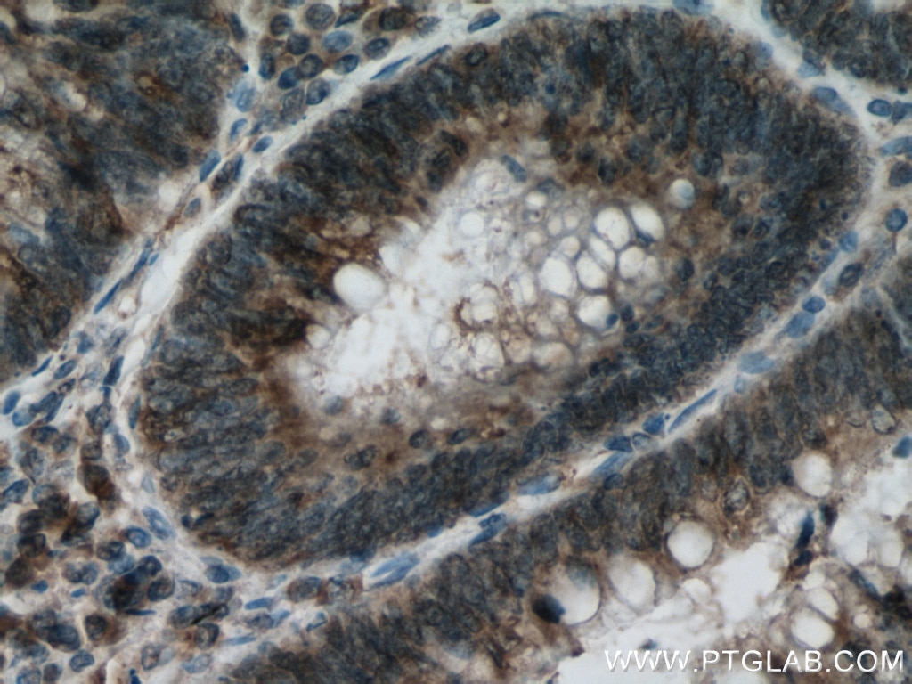 Immunohistochemistry (IHC) staining of human colon cancer tissue using HIP1 Monoclonal antibody (67163-1-Ig)